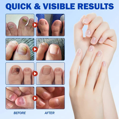 Fungal Nail Treatment Patches